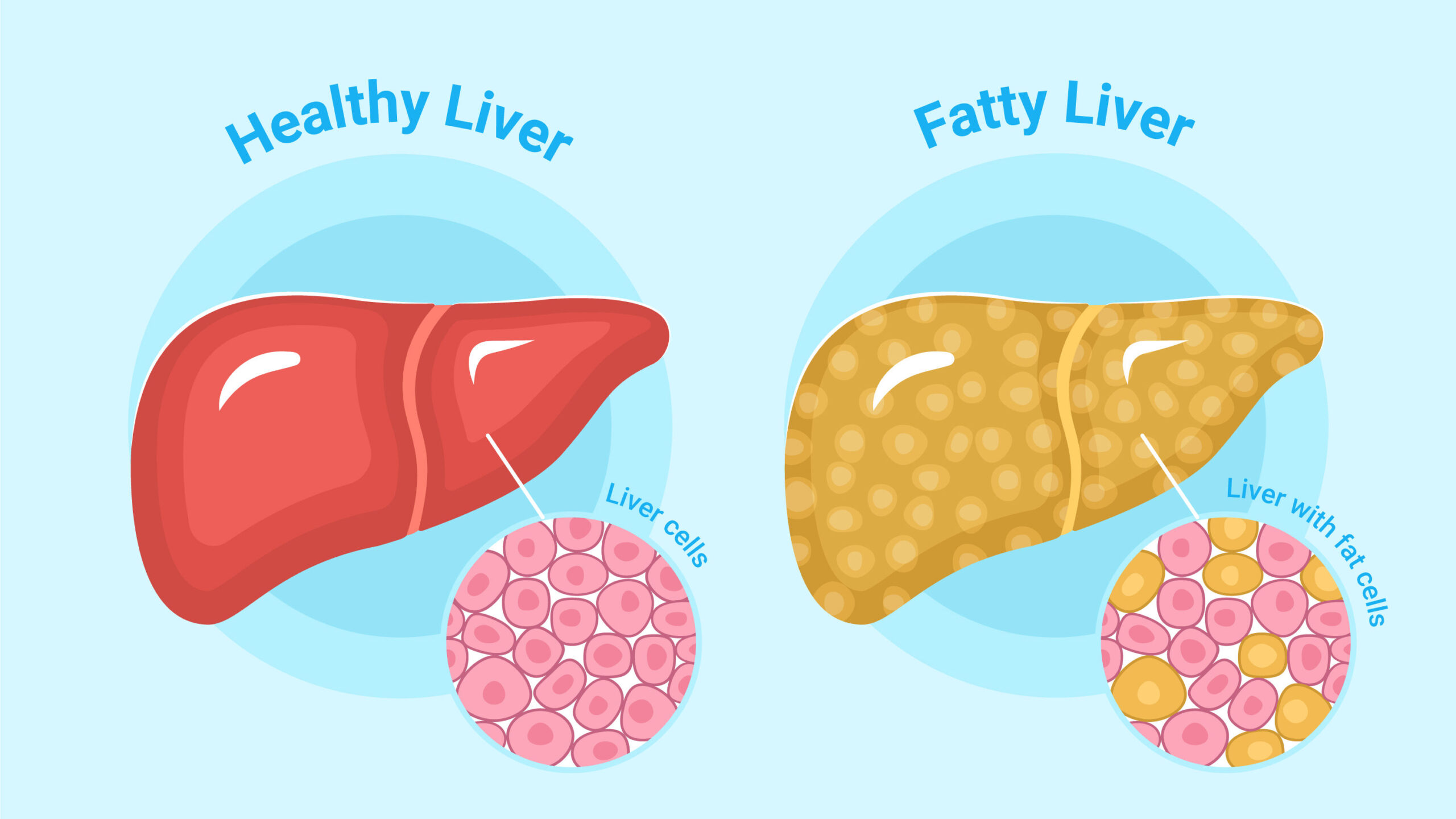 Fatty liver
